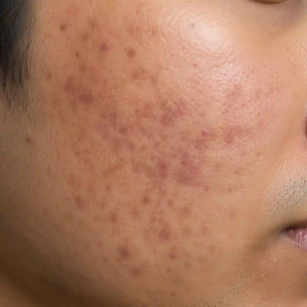 Post-acne scar