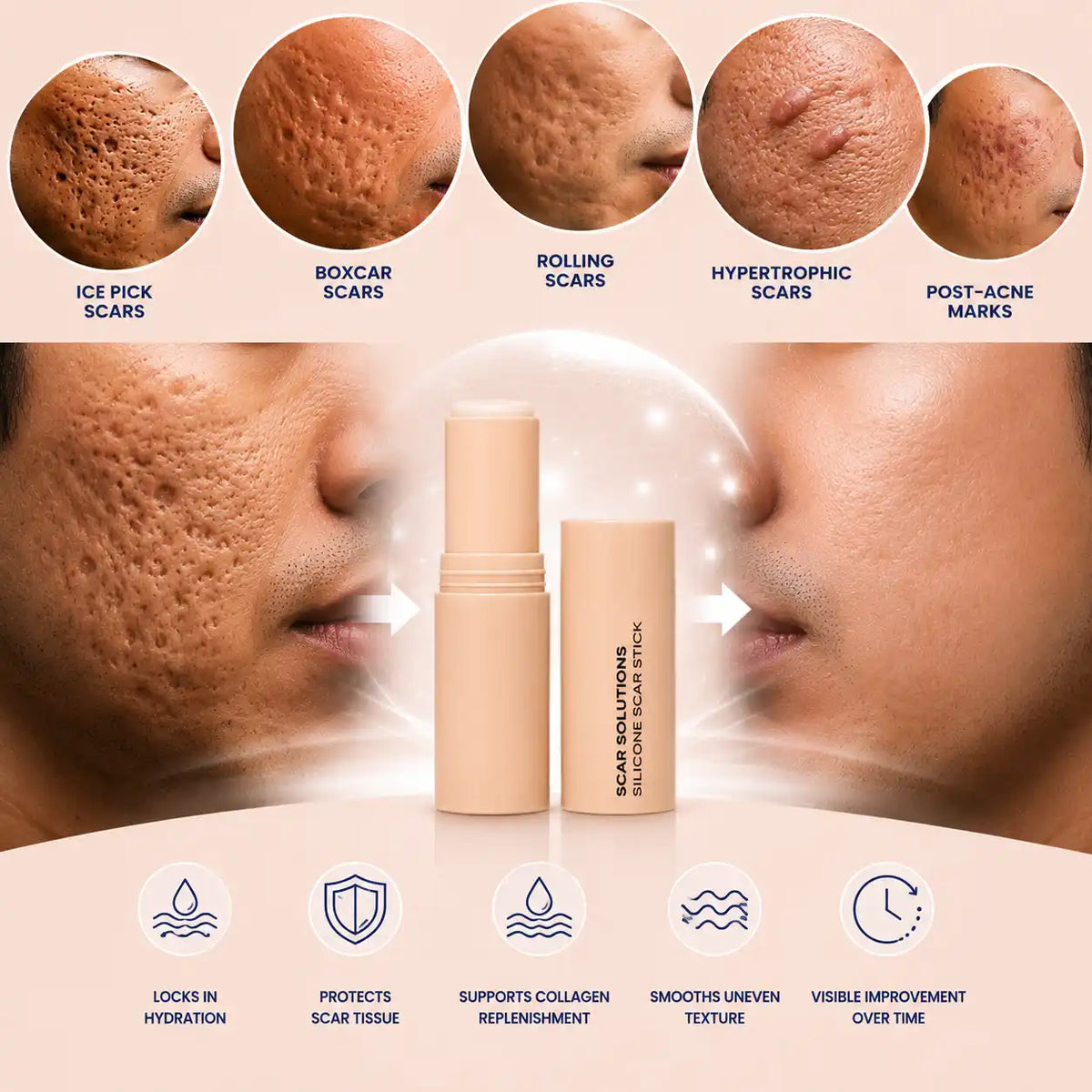 Acne Swipe Stick